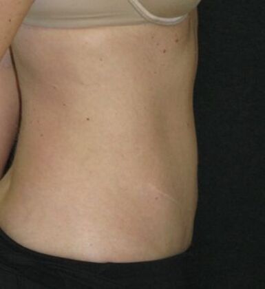 Abdominoplasty: Case 11 - After