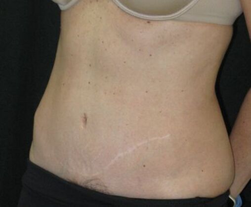 Abdominoplasty: Case 11 - After