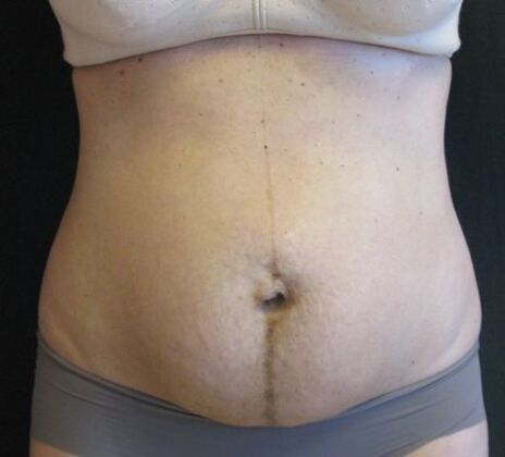 Abdominoplasty: Case 11 - Before