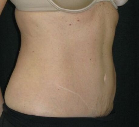Abdominoplasty: Case 11 - After