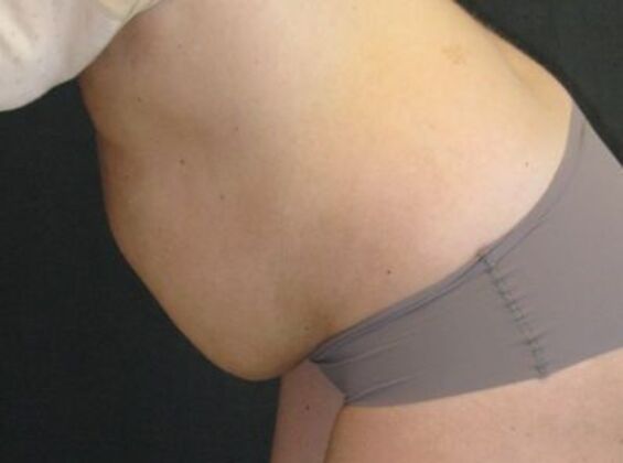Abdominoplasty: Case 11 - Before