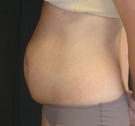 Abdominoplasty: Case 11 - Before