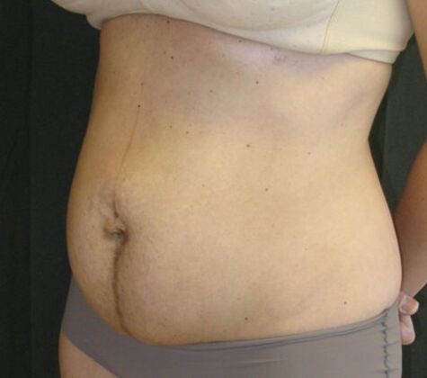 Abdominoplasty: Case 11 - Before