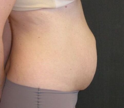 Abdominoplasty: Case 11 - After