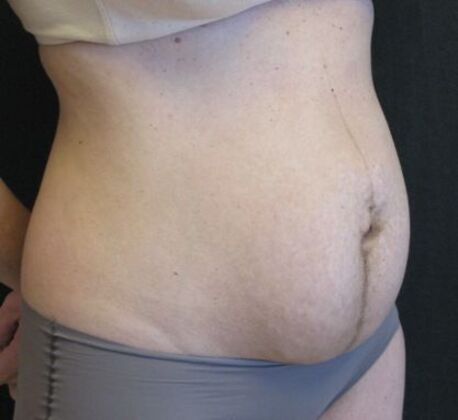 Abdominoplasty: Case 11 - Before