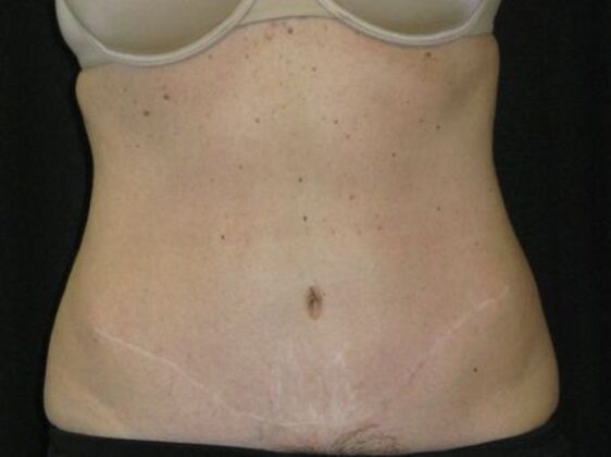 Abdominoplasty: Case 11 - After