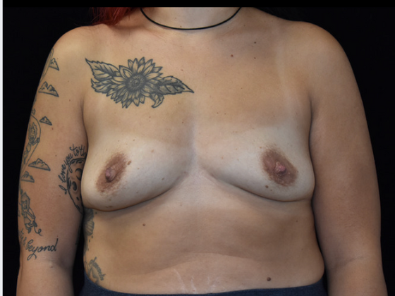Breast Augmentation Case 9 - Before