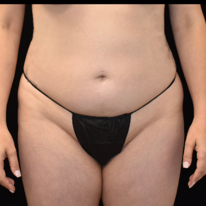 Liposuction Case 1 - Before