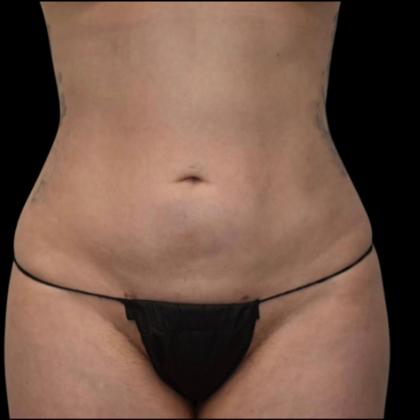 Liposuction Case 1 - After