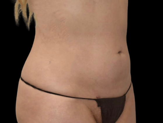Liposuction: Case 1 - After