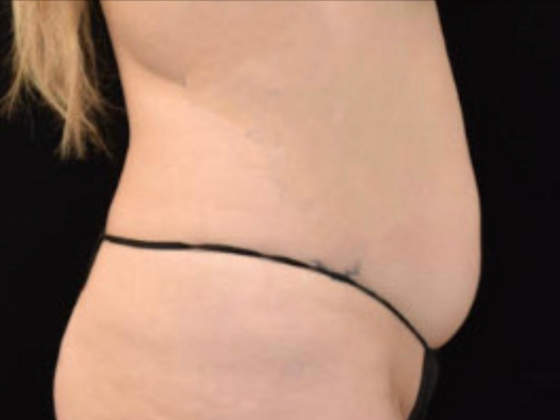Liposuction: Case 1 - Before