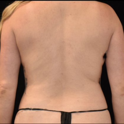 Liposuction: Case 1 - Before