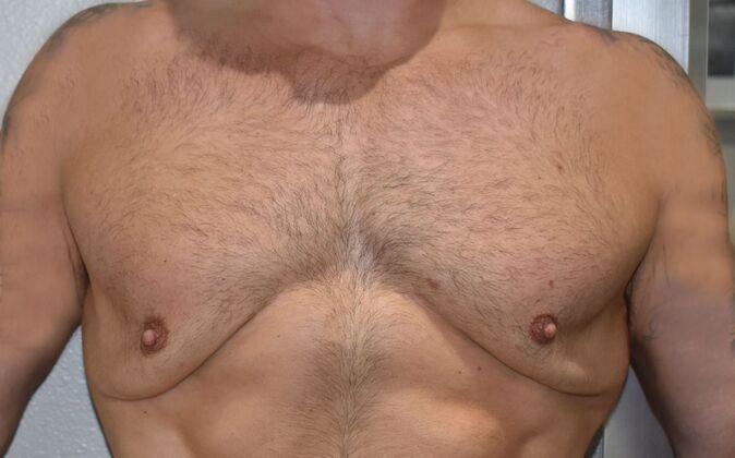 Gynecomastia Case 7 - Before
