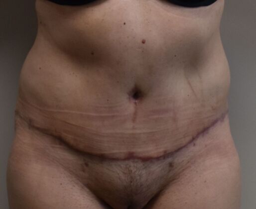 Tummy Tuck (Abdominoplasty): Case 443 - After