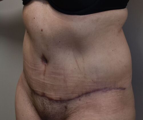 Tummy Tuck (Abdominoplasty): Case 443 - After