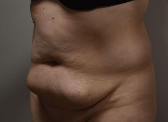 Tummy Tuck (Abdominoplasty): Case 443 - Before