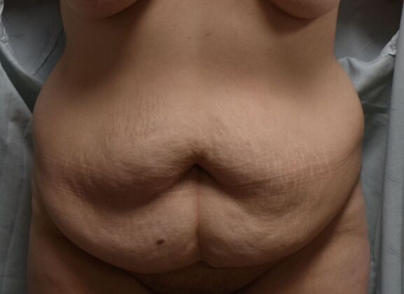 Tummy Tuck (Abdominoplasty): Case 400 - Before