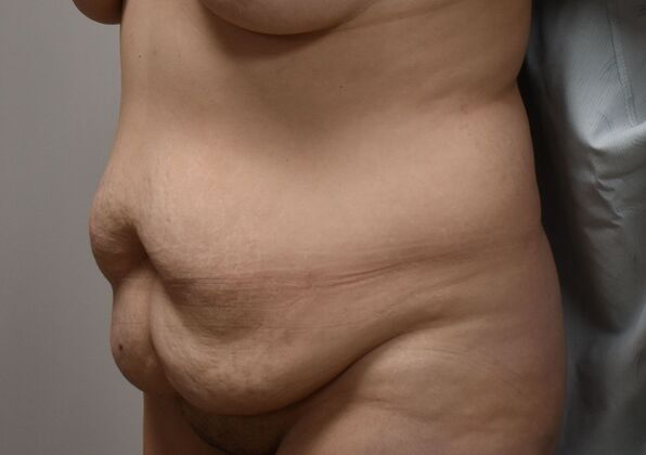 Tummy Tuck (Abdominoplasty): Case 400 - Before