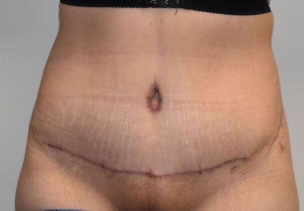 Tummy Tuck (Abdominoplasty): Case 400 - After