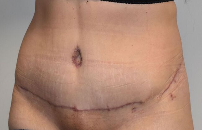 Tummy Tuck (Abdominoplasty): Case 400 - After