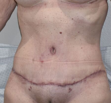 Tummy Tuck (Abdominoplasty): Case 445 - After