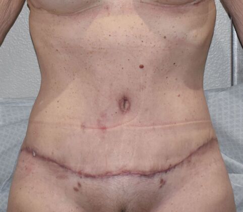 Tummy Tuck (Abdominoplasty): Case 445 - After