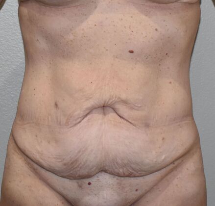 Tummy Tuck (Abdominoplasty): Case 445 - Before