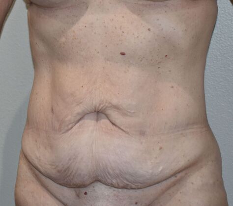 Massive Weight Loss : Case 139 - Before