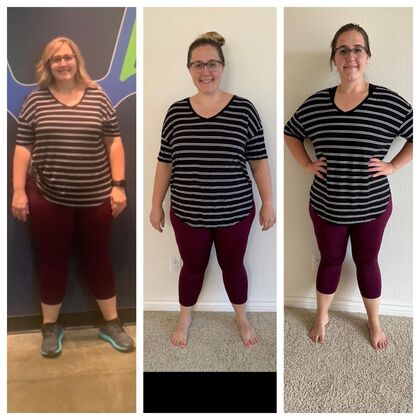 Gastric Sleeve - Click Here to See More! : Ashley A - Before / After