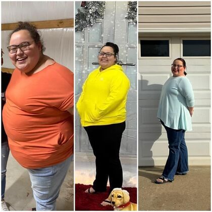 Gastric Sleeve - Click Here to See More! : Anna C - Before / After