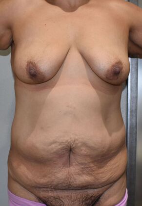 Mommy Makeover Case 288 - Before