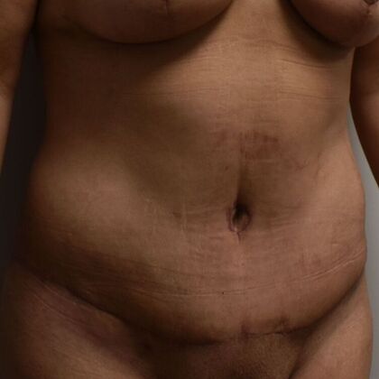 Tummy Tuck (Abdominoplasty): Case 446 - After