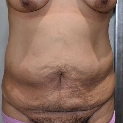 Tummy Tuck (Abdominoplasty): Case 446 - Before