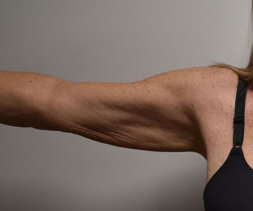 Brachioplasty Case 19 - Before