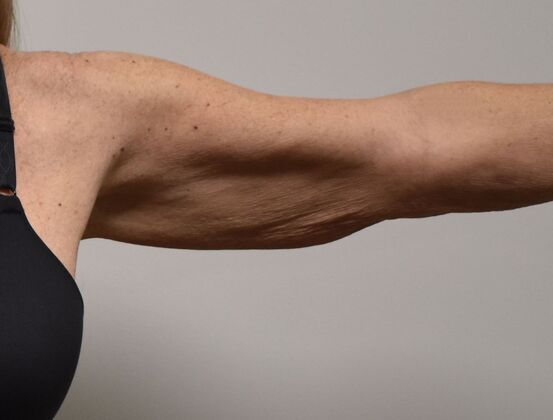 Brachioplasty: Case 19 - Before