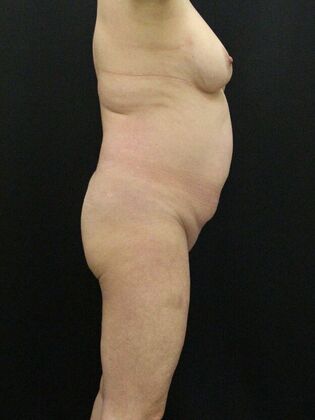 Brazilian Butt Lift: Case 7 - Before