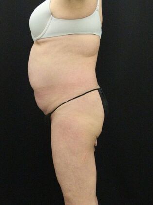 Brazilian Butt Lift: Case 7 - Before