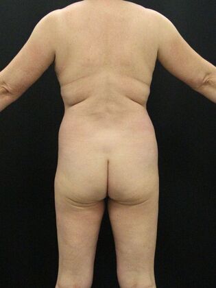 Brazilian Butt Lift Case 7 - Before