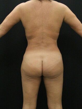 Brazilian Butt Lift Case 7 - After