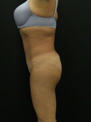 Brazilian Butt Lift: Case 7 - After