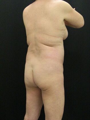 Brazilian Butt Lift: Case 7 - Before