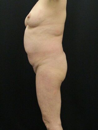 Liposuction: Case 20 - Before