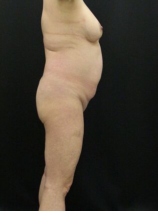 Liposuction: Case 20 - Before