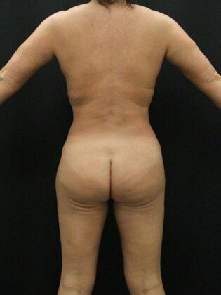 Liposuction Case 20 - After