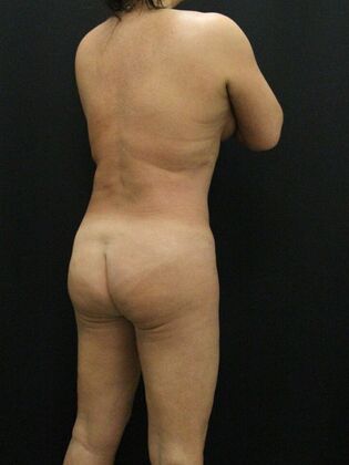 Liposuction: Case 20 - After