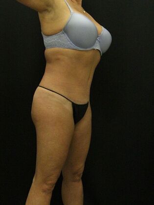 Liposuction: Case 20 - After