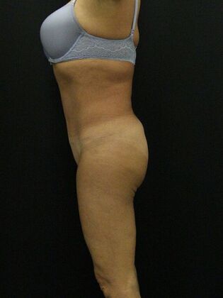 Liposuction: Case 20 - After