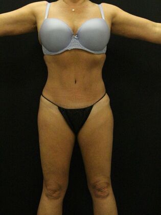 Liposuction: Case 20 - After