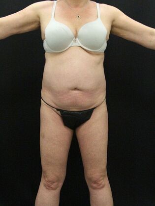 Liposuction: Case 20 - Before