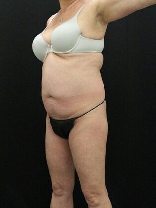 Liposuction: Case 20 - After